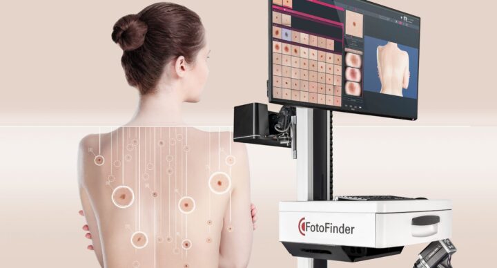 Fotofinder skin checks